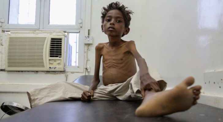 Five year-old Mohannad Ali sits starving in a hospital bed. His younger cousin, aged two, already died of hunger. (Photo Credit: UNICEF)