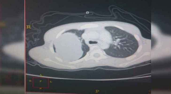 A scan showing what the girl's lungs with the cyst would have looked like. (Roya)