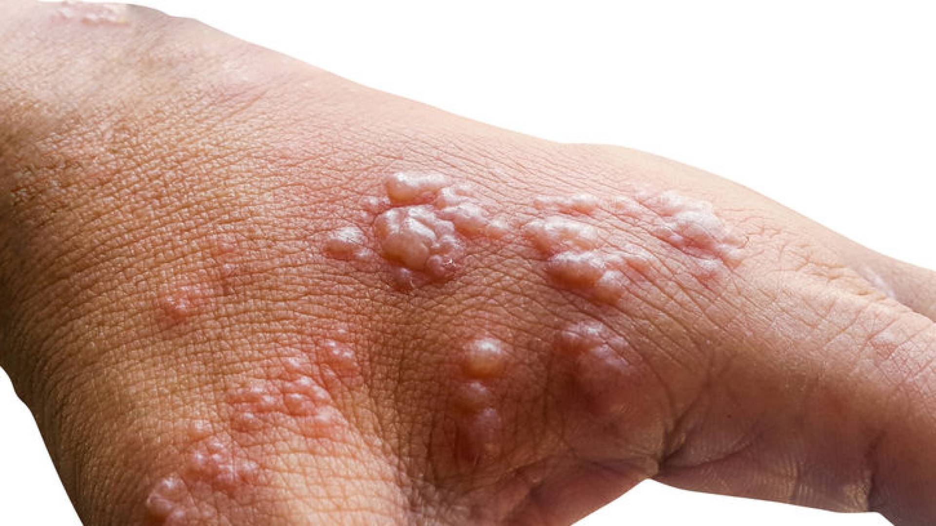 Philippines records first monkeypox case since December