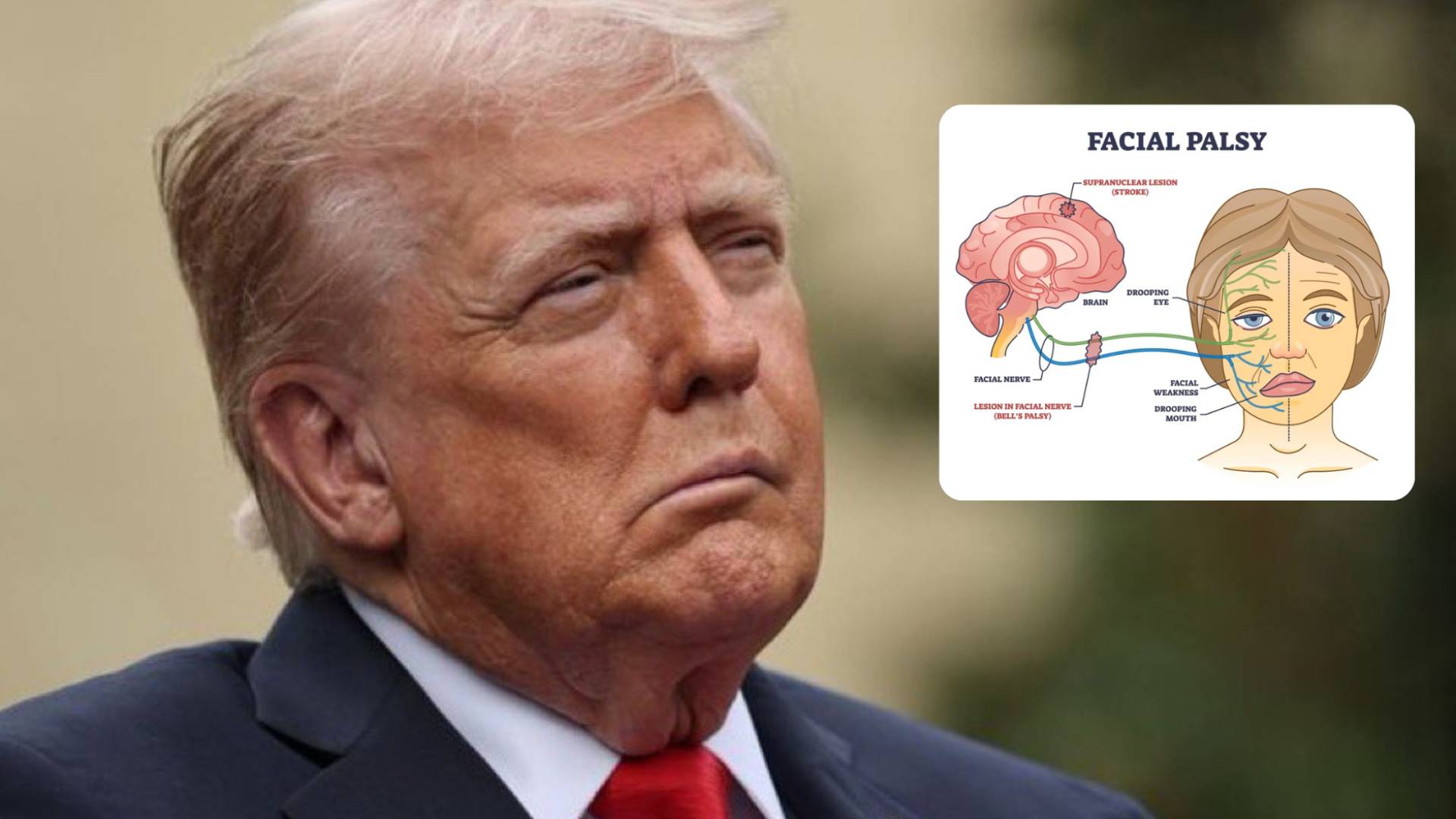 Did Donald Trump have a stroke?