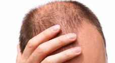 Turkish doctors arrested for unauthorized hair transplantations