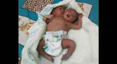 Sudanese woman gives birth to rare conjoined twins