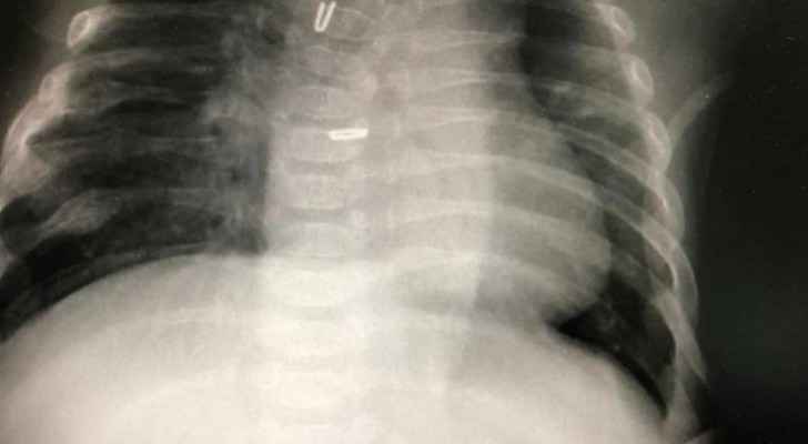 Surgeons repair esophageal obstruction in newborn baby: JUH