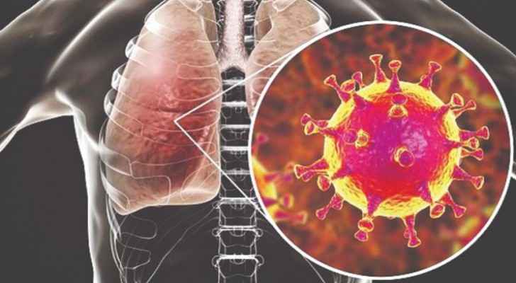 COVID-19 transforms lungs to stone: study